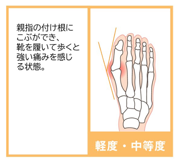軽度・中等度の外反母趾:親指の付け根にこぶができ、靴を履いて歩くと強い痛みを感じる状態